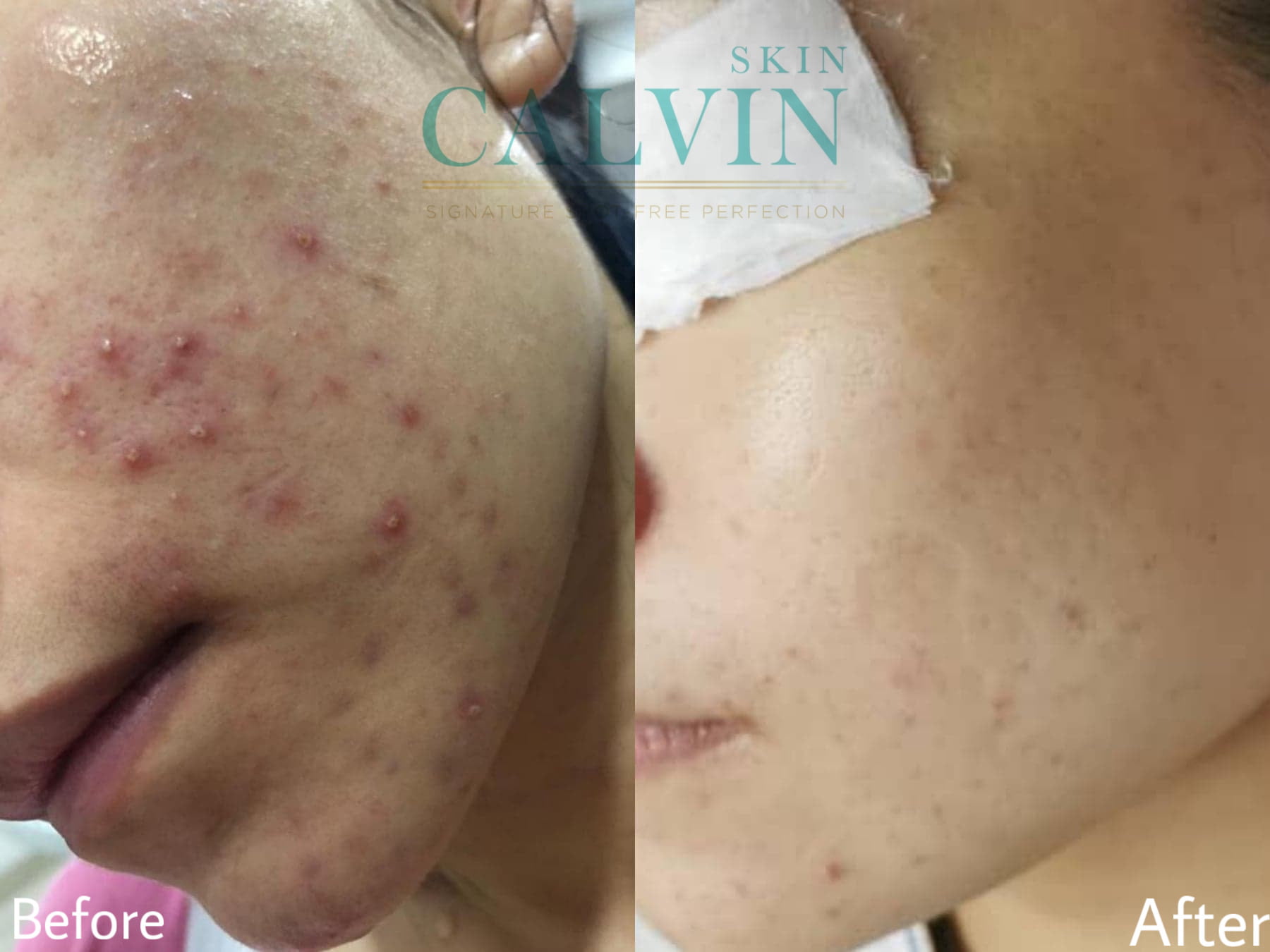 Acne-Recover-Solution-before-after-01