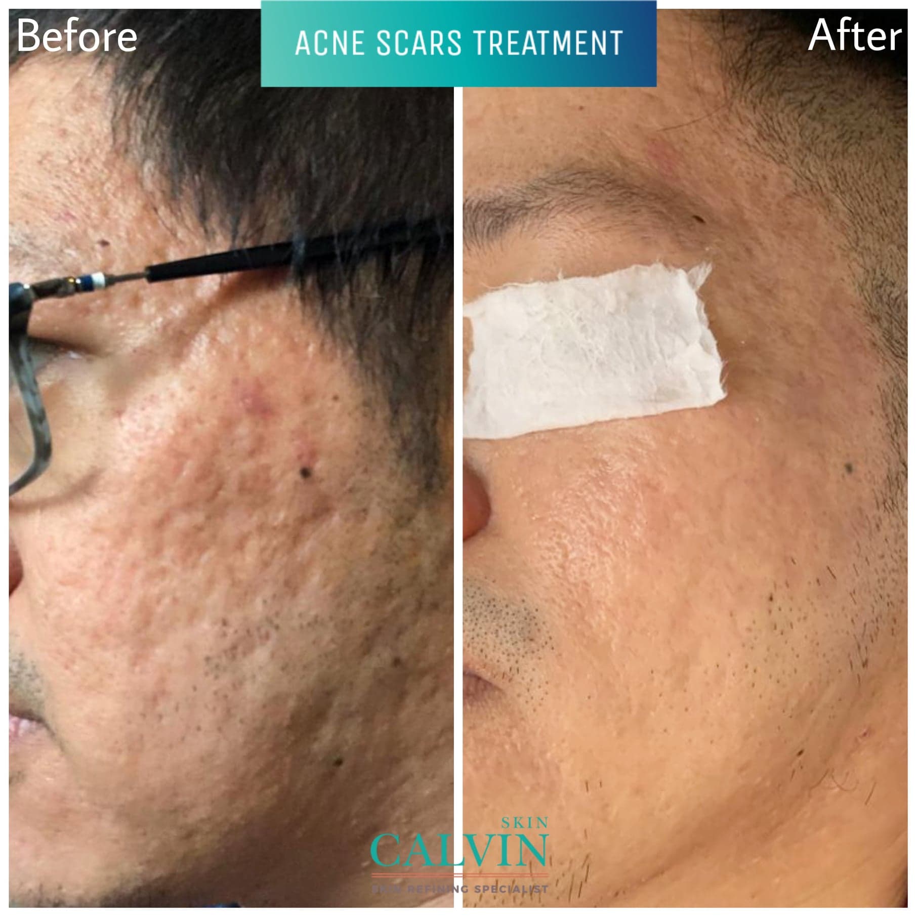 Multi-Collagen-before-after-02